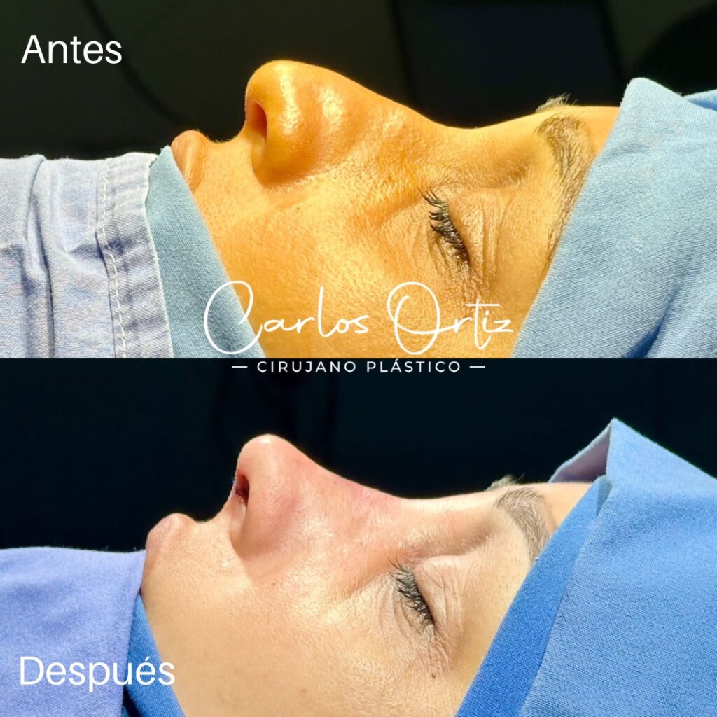 Rinoplastia estética colombia medellin