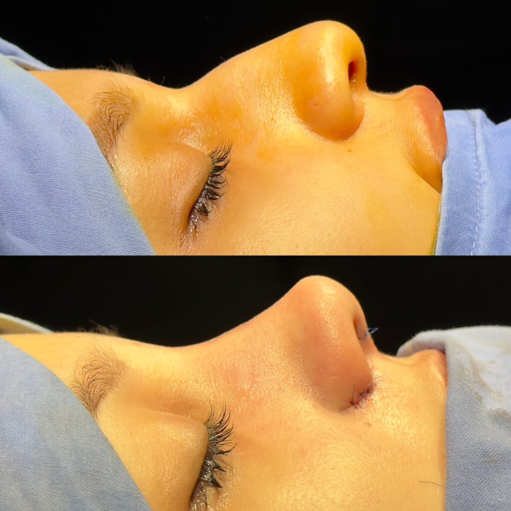 Rinoplastia nariz chata medellin colombia