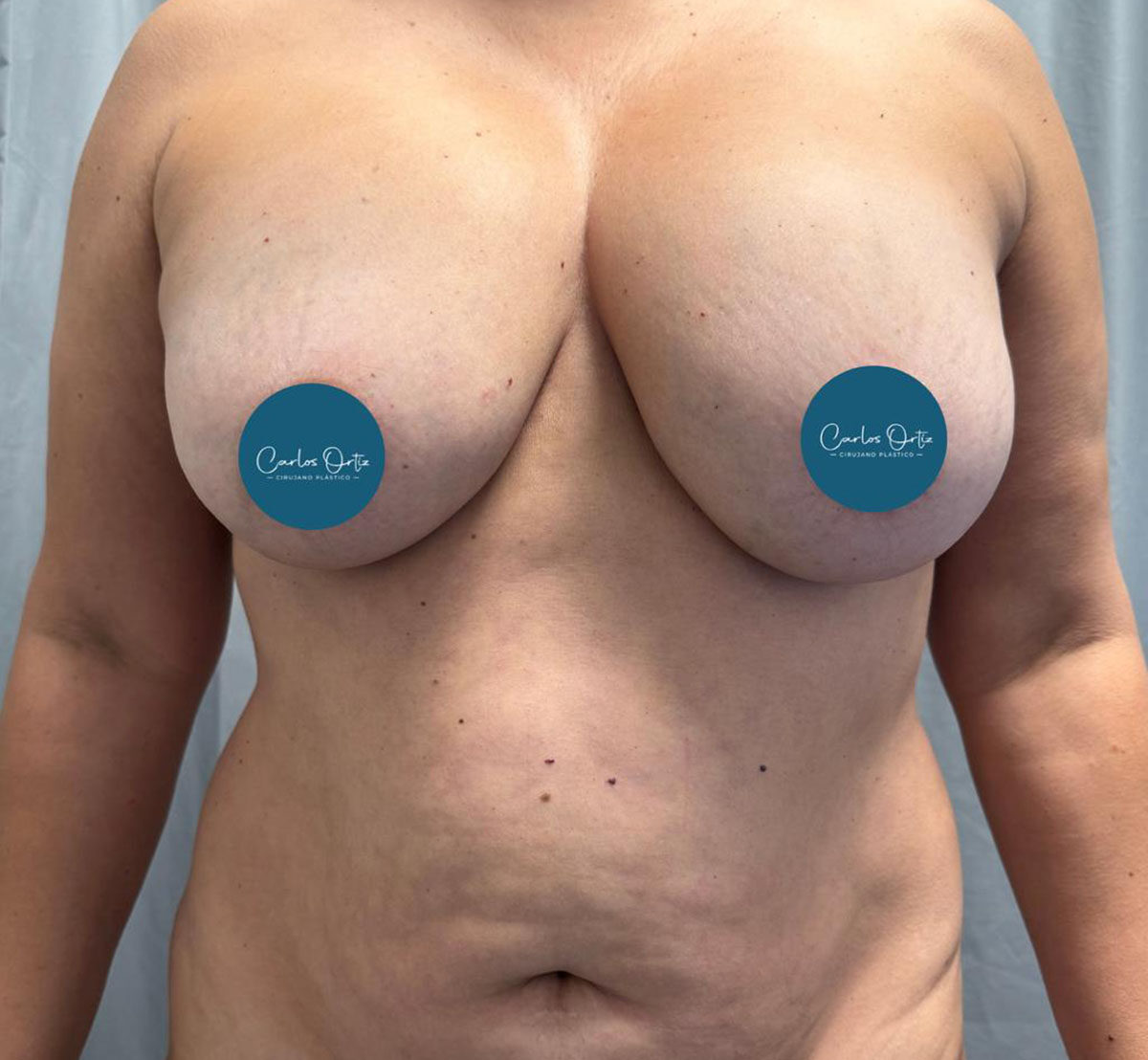 Abdominoplastia-Antes-1-1-1108