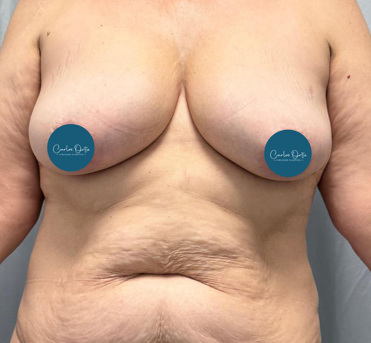 Abdominoplastia-Antes-2-1-1108