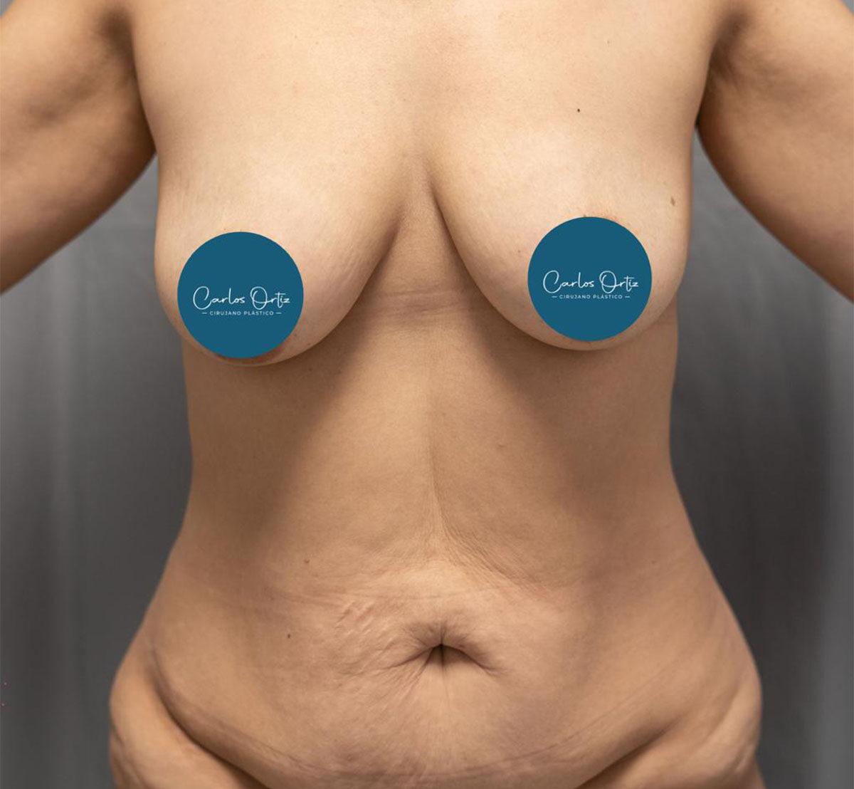 Abdominoplastia-Antes-3-1-1108