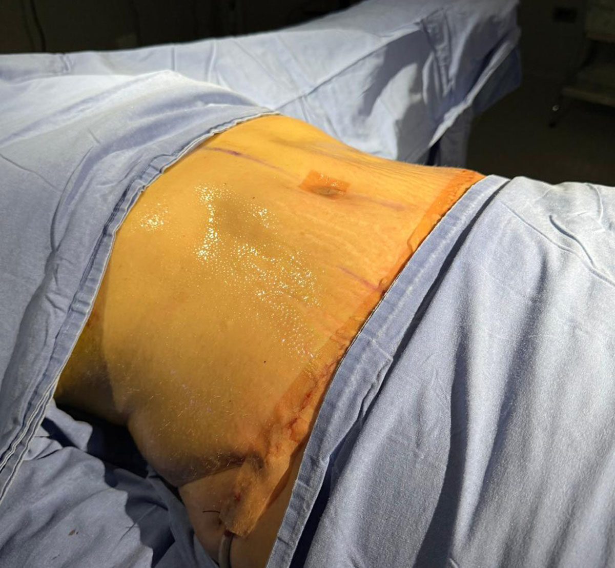 Abdominoplastia-Depués-2-2-1108