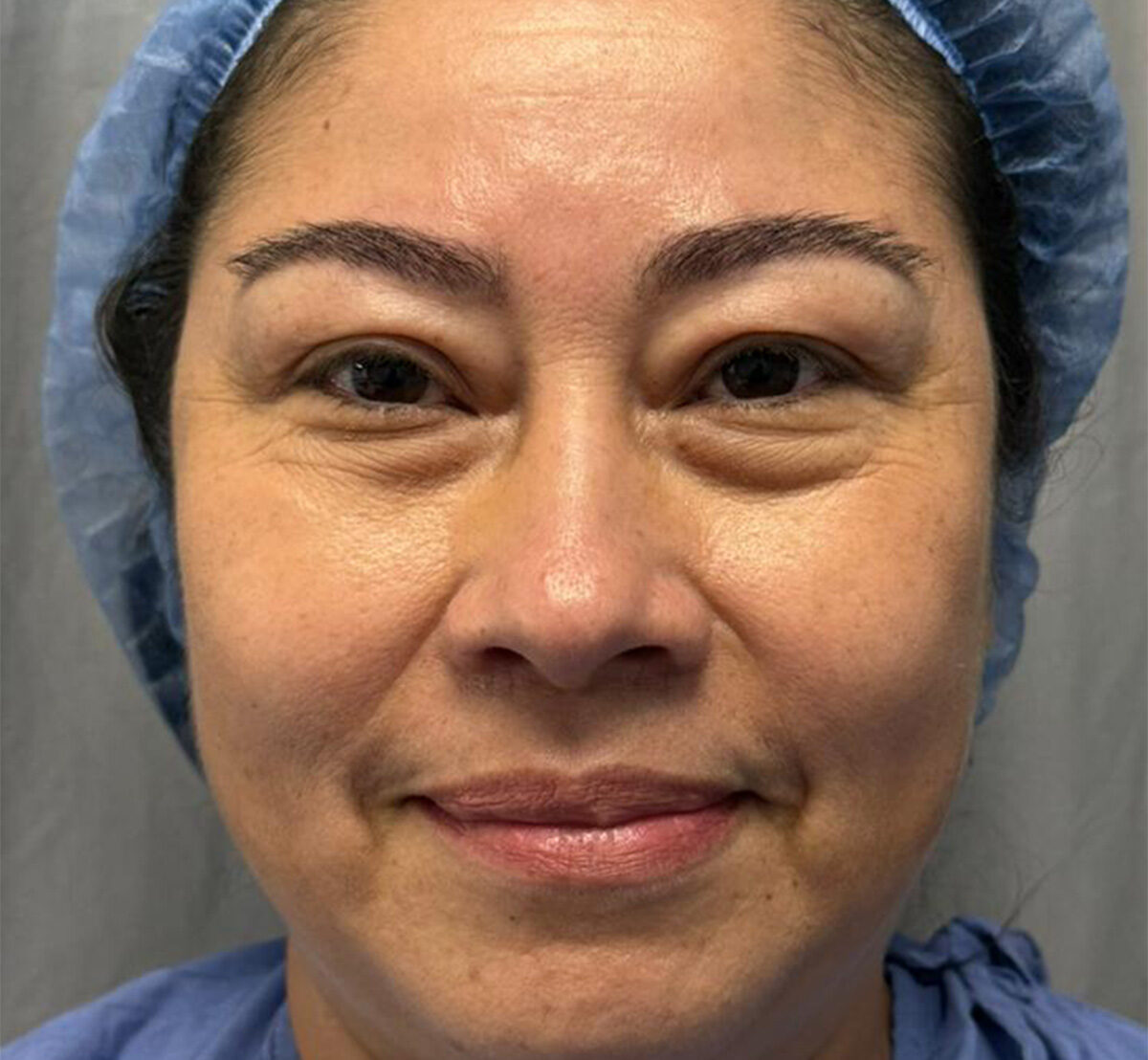 Blefaroplastia-Antes-1-1-1108-5