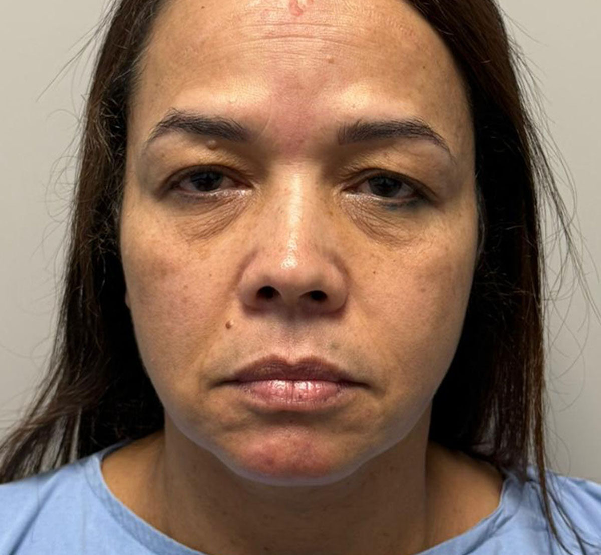 Blefaroplastia-Antes-2-1-1108-1