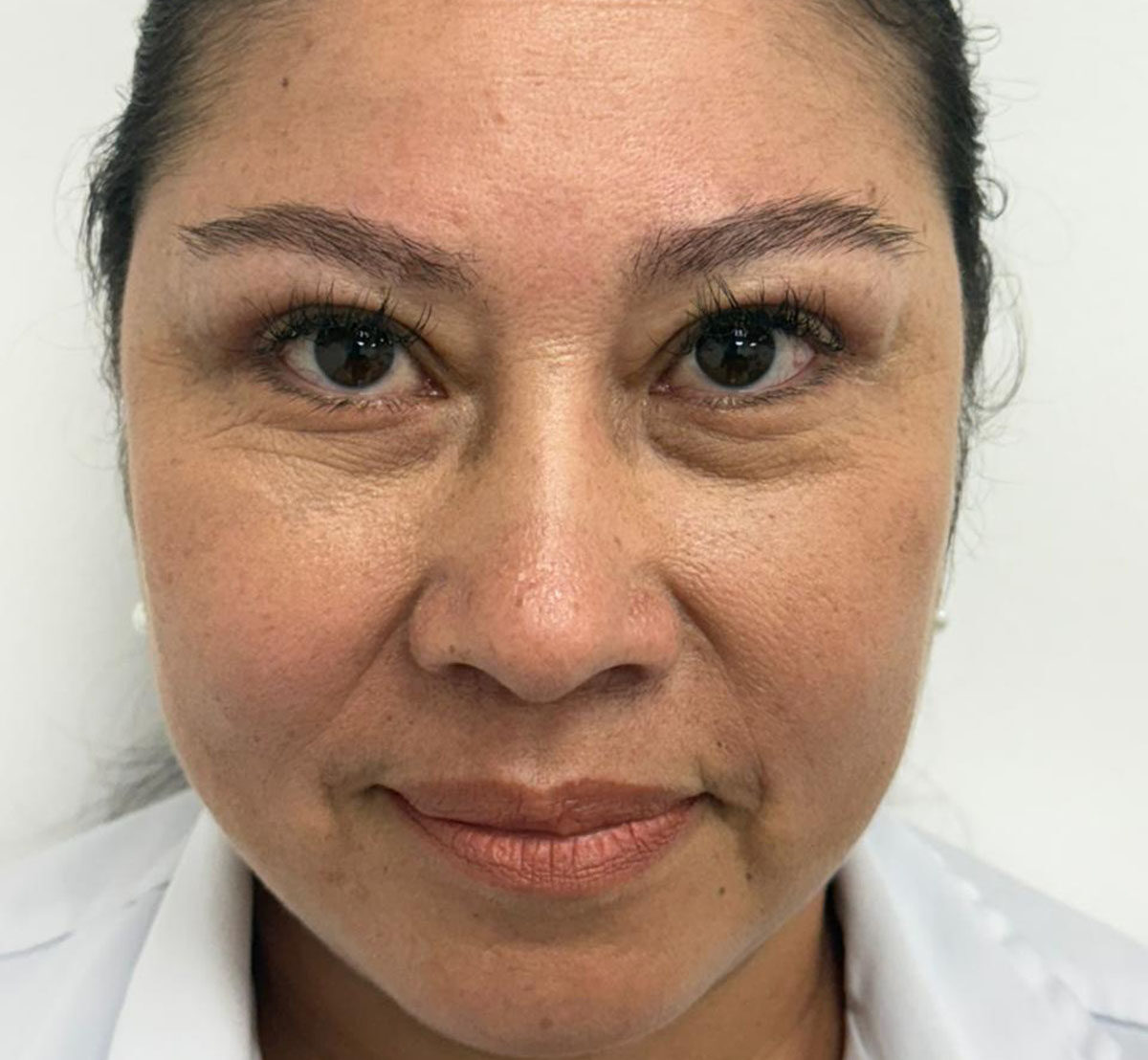 Blefaroplastia-Después-1-2-1108-1