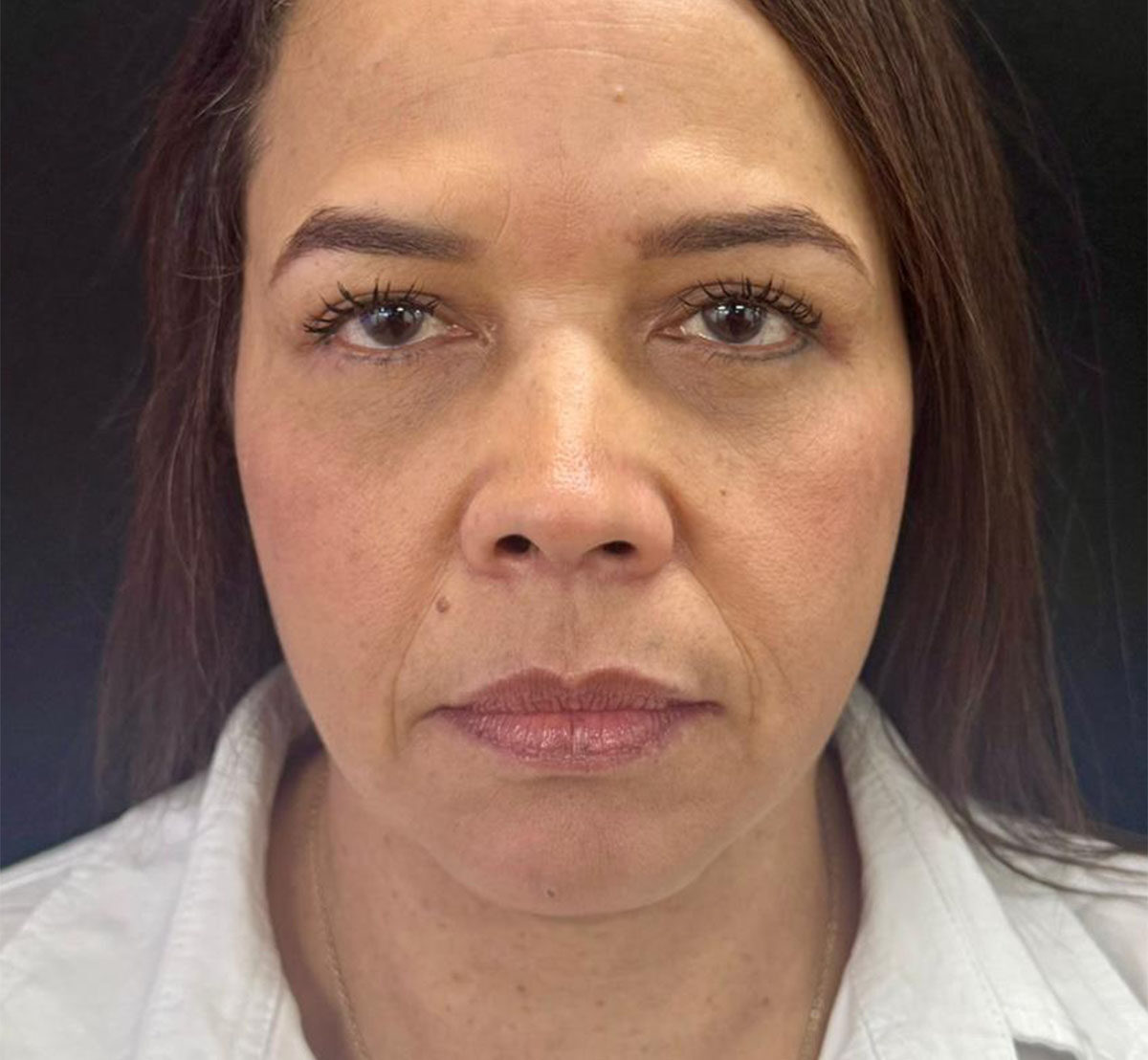 Blefaroplastia-Después-2-2-1108-2