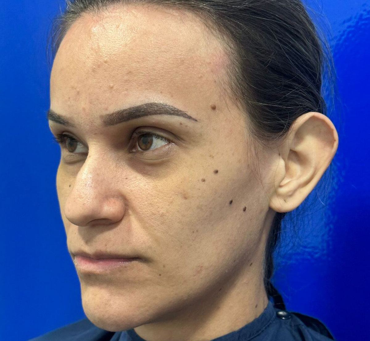 Otoplastia-Antes-2-1-1108-2