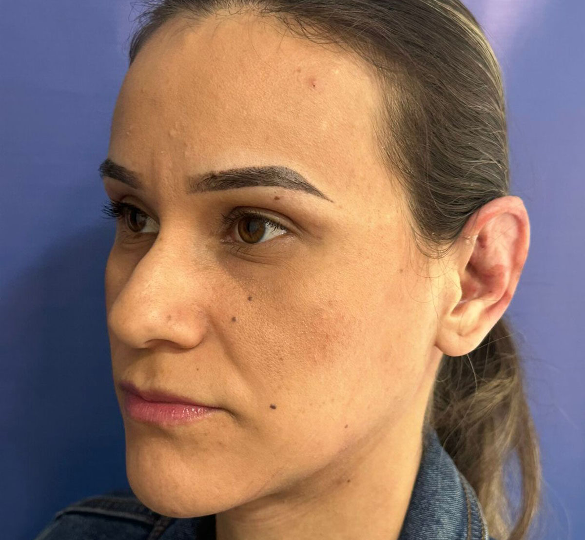 Otoplastia-Antes-2-1-1108